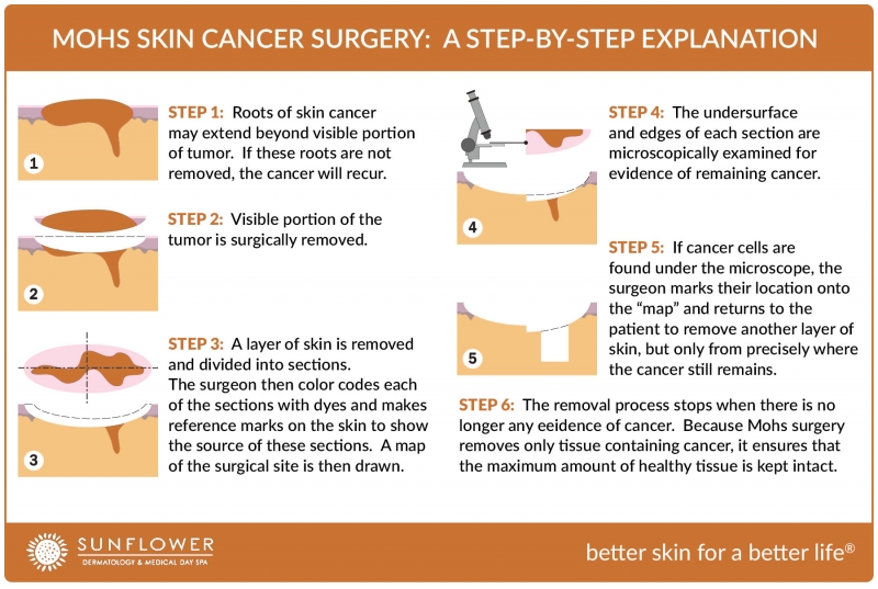 A Step-by-Step Guide to the Mohs Skin Cancer Surgery Procedure